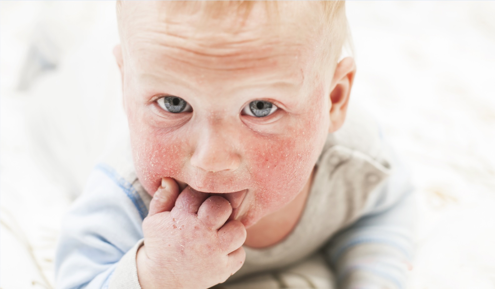 Атопический дерматит у детей: советы и способы облегчить симптомы