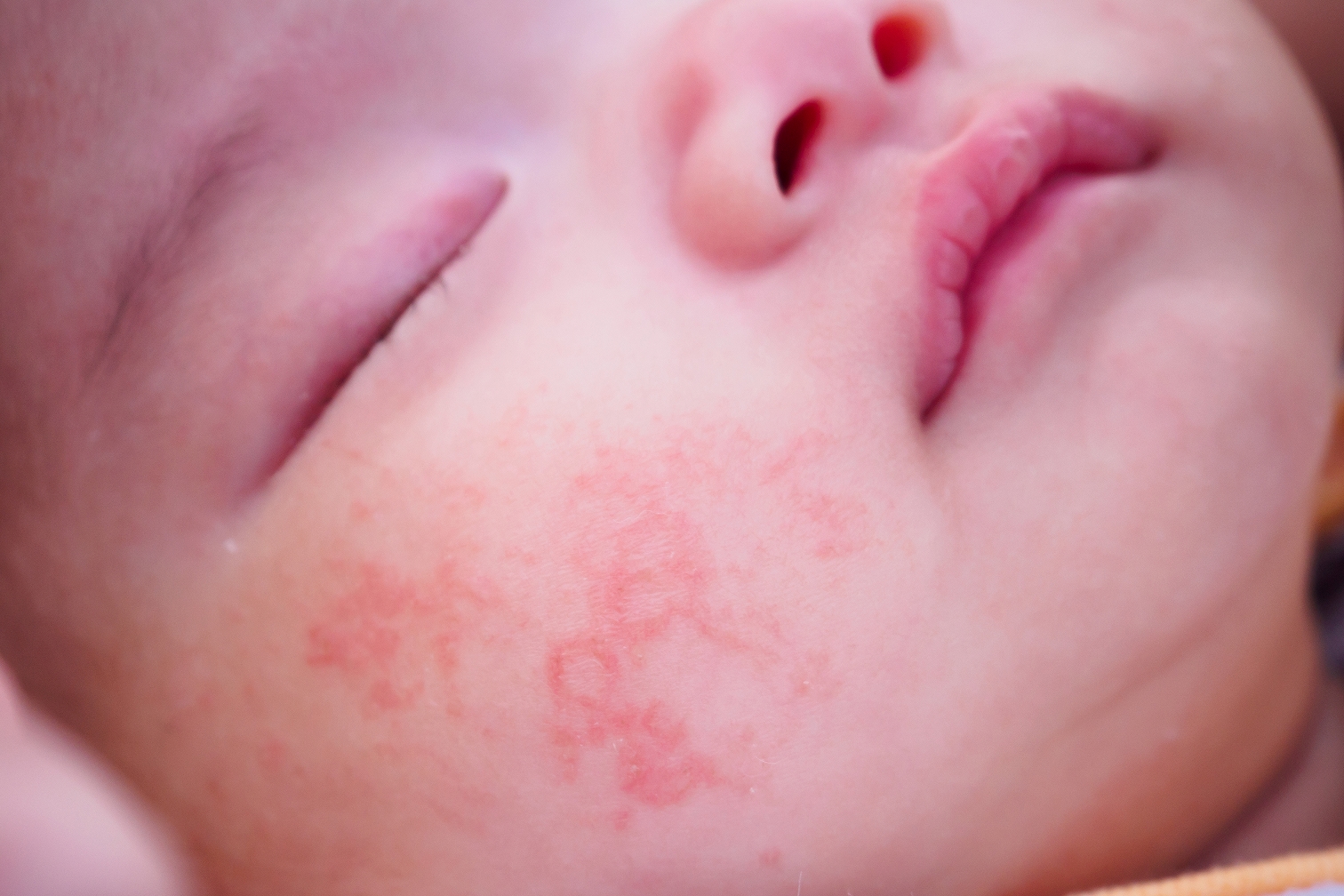 Эффективное лечение атопического дерматита теперь доступно и детям с 6 лет